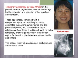 Temporary anchorage devices (TADs) in the
posterior dental region were used as anchorage
for the retraction and intrusion of her maxillary
anterior teeth.
Those appliances, combined with a
compensatory curved maxillary archwire,
eliminated the severe gummy smile and the
protrusive profile, and corrected the molar
relationship from Class II to Class I. With no extra
temporary anchorage devices in the anterior
region for intrusion, the treatment was workable
and simple.
The patient received a satisfactory occlusion and
an attractive smile.
Pretreatment
 