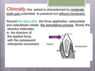 Clinically, this period is characterized by moderate
tooth pain submitted to pressure but without movement.
Around two days after the force application, osteoclasts
and osteoblasts initiate the remodeling process. Slowly the
alveolus dislocates
in the direction of
the applied force,
with the subsequent
orthodontic movement.
 