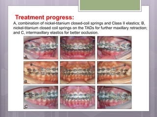 Treatment progress:
A, combination of nickel-titanium closed-coil springs and Class II elastics; B,
nickel-titanium closed coil springs on the TADs for further maxillary retraction;
and C, intermaxillary elastics for better occlusion.
 