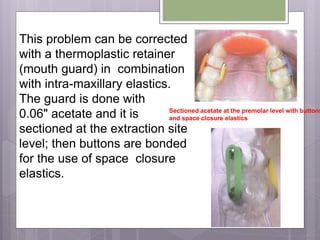 This problem can be corrected
with a thermoplastic retainer
(mouth guard) in combination
with intra-maxillary elastics.
The guard is done with
0.06" acetate and it is
sectioned at the extraction site
level; then buttons are bonded
for the use of space closure
elastics.
Sectioned acetate at the premolar level with buttons
and space closure elastics
 