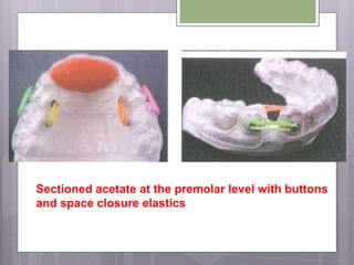 Sectioned acetate at the premolar level with buttons
and space closure elastics
 