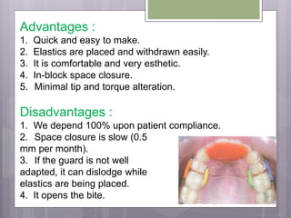 Advantages :
1. Quick and easy to make.
2. Elastics are placed and withdrawn easily.
3. It is comfortable and very esthetic.
4. In-block space closure.
5. Minimal tip and torque alteration.
Disadvantages :
1. We depend 100% upon patient compliance.
2. Space closure is slow (0.5
mm per month).
3. If the guard is not well
adapted, it can dislodge while
elastics are being placed.
4. It opens the bite.
 