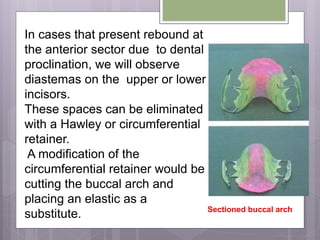 In cases that present rebound at
the anterior sector due to dental
proclination, we will observe
diastemas on the upper or lower
incisors.
These spaces can be eliminated
with a Hawley or circumferential
retainer.
A modification of the
circumferential retainer would be
cutting the buccal arch and
placing an elastic as a
substitute. Sectioned buccal arch
 