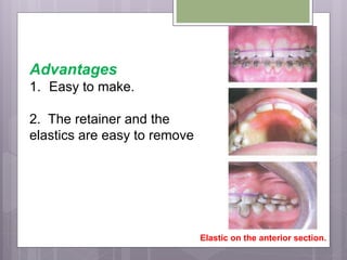 Advantages
1. Easy to make.
2. The retainer and the
elastics are easy to remove
Elastic on the anterior section.
 