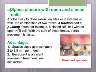 a)Space closure with open and closed
coils
Another way to close extraction sites or diastemas is
with the combination of two forces: a traction and a
pushing force; for example, a closed NiTi coil with an
open NiTi coil. With the sum of these forces, dental
movement is faster.
Advantages
1. Spaces close approximately
2 to 2.5 mm per month.
2. Because it is a violent
movement treatment time
diminishes.
Closed and open coils
 
