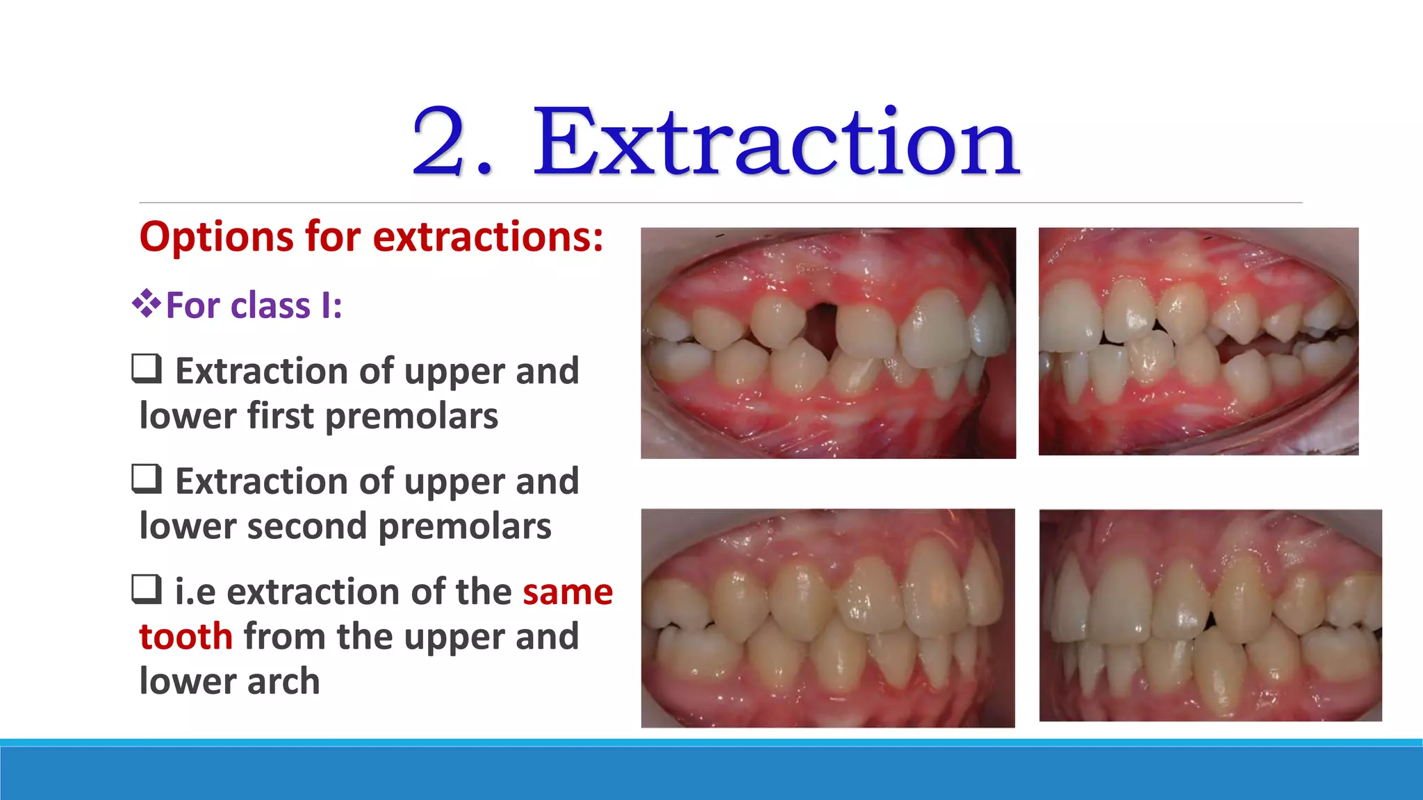 2. Extraction
Options for extractions:
For class I:
 Extraction of upper and
lower first premolars
 Extraction of upper and
lower second premolars
 i.e extraction of the same
tooth from the upper and
lower arch
 
