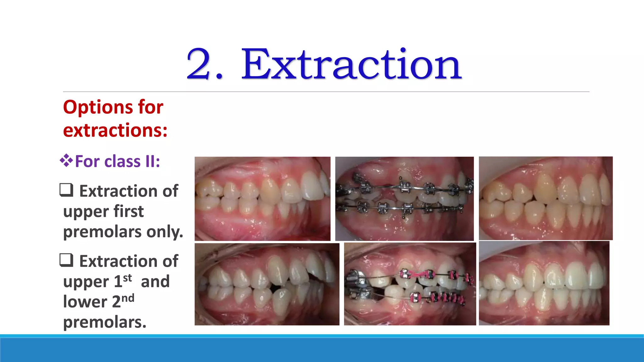 2. Extraction
Options for
extractions:
For class II:
 Extraction of
upper first
premolars only.
 Extraction of
upper 1st and
lower 2nd
premolars.
 