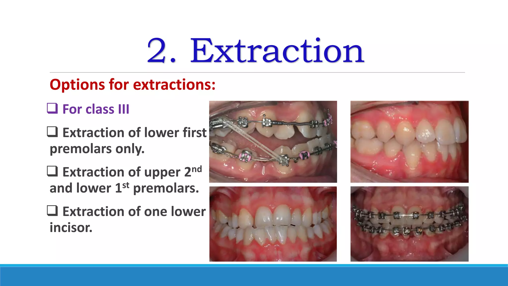2. Extraction
Options for extractions:
 For class III
 Extraction of lower first
premolars only.
 Extraction of upper 2nd
and lower 1st premolars.
 Extraction of one lower
incisor.
 