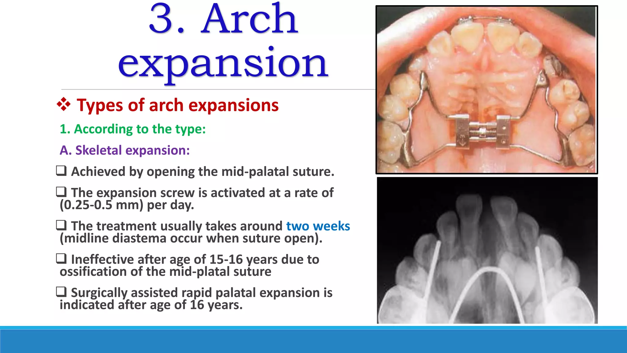 3. Arch
expansion
 Types of arch expansions
1. According to the type:
A. Skeletal expansion:
 Achieved by opening the mid-palatal suture.
 The expansion screw is activated at a rate of
(0.25-0.5 mm) per day.
 The treatment usually takes around two weeks
(midline diastema occur when suture open).
 Ineffective after age of 15-16 years due to
ossification of the mid-platal suture
 Surgically assisted rapid palatal expansion is
indicated after age of 16 years.
 
