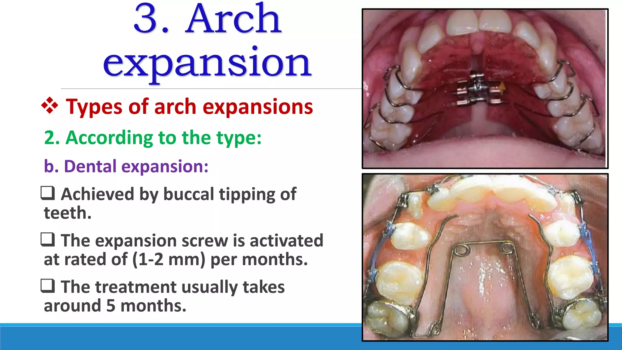 3. Arch
expansion
 Types of arch expansions
2. According to the type:
b. Dental expansion:
 Achieved by buccal tipping of
teeth.
 The expansion screw is activated
at rated of (1-2 mm) per months.
 The treatment usually takes
around 5 months.
 