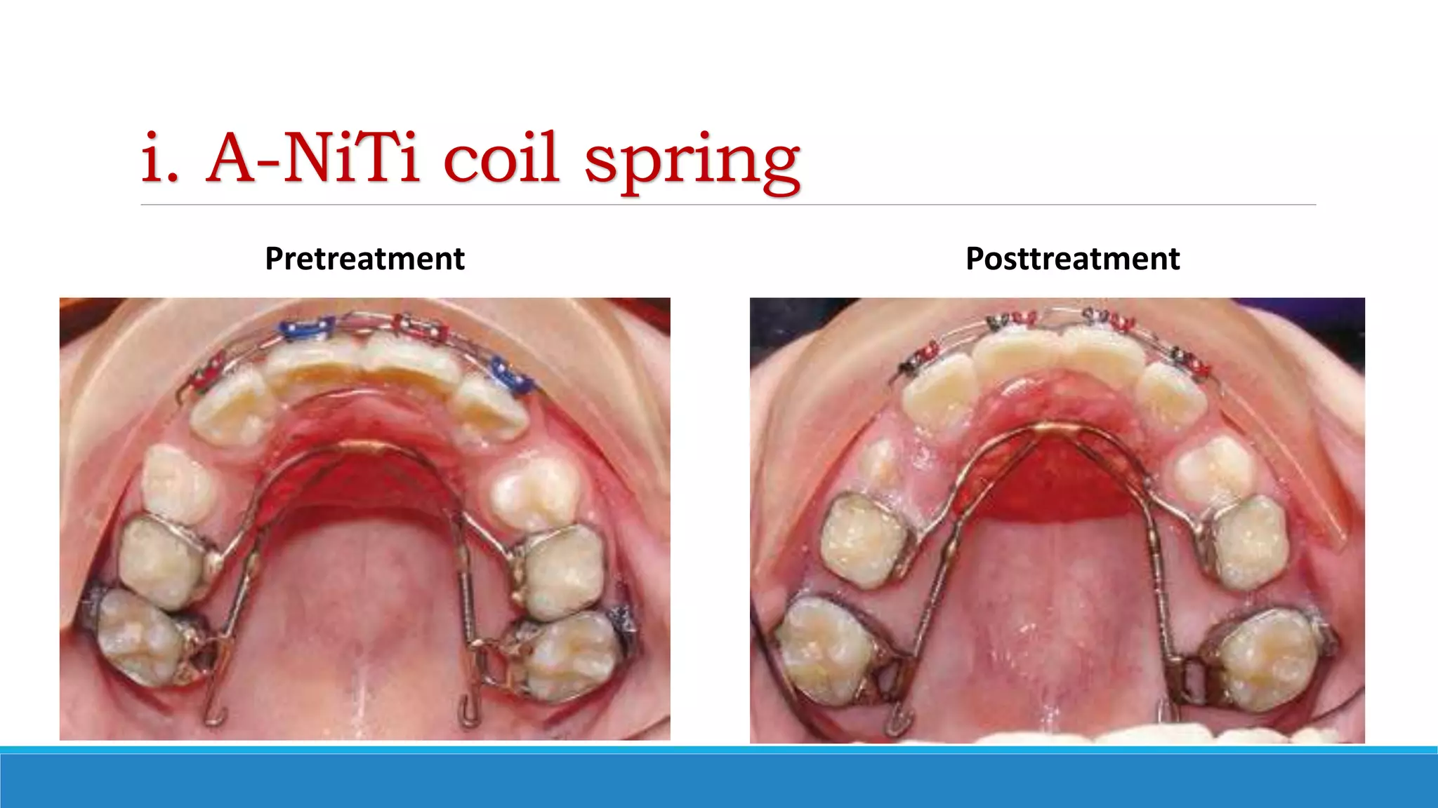 i. A-NiTi coil spring
Pretreatment Posttreatment
 