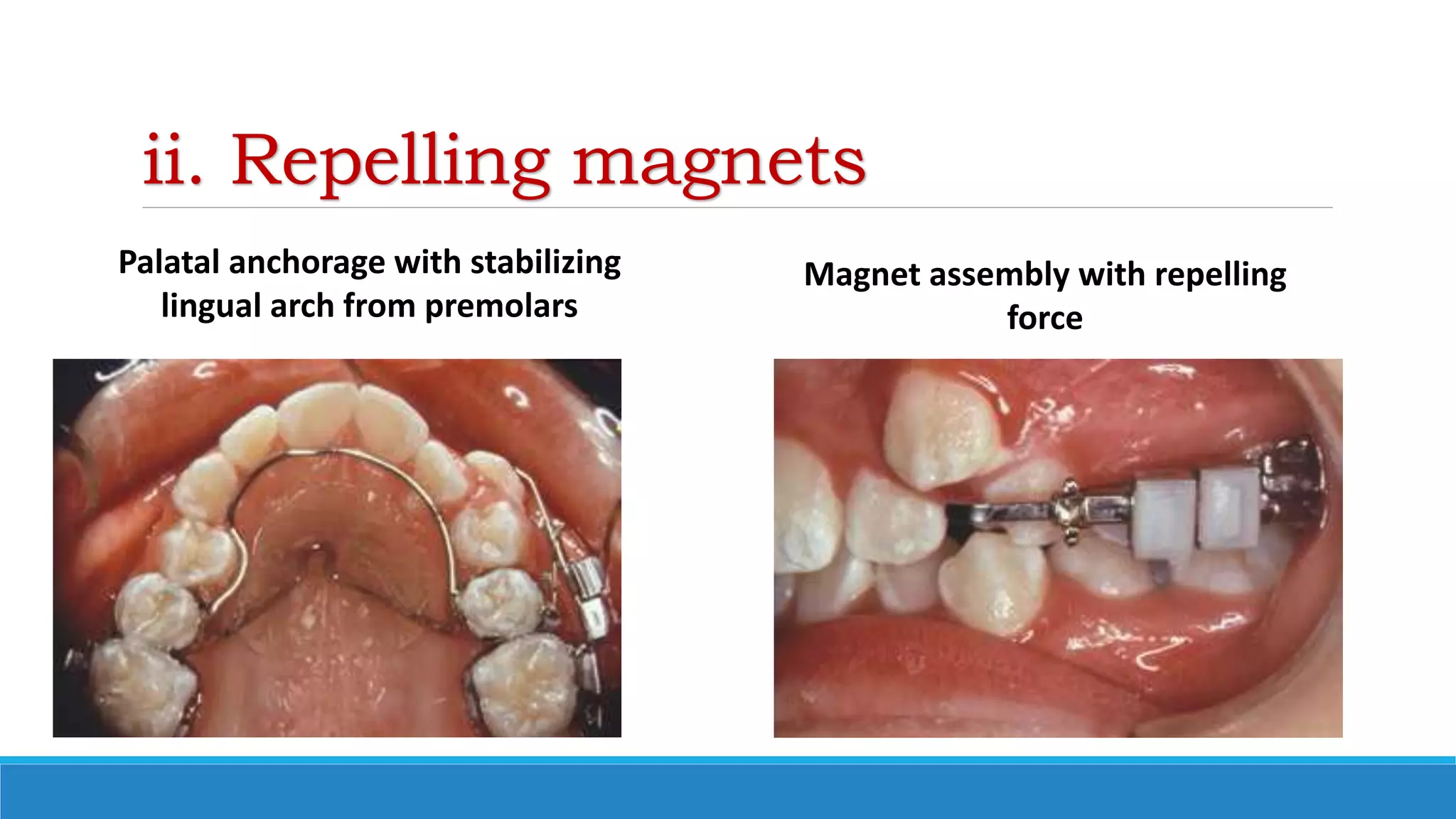 ii. Repelling magnets
Palatal anchorage with stabilizing
lingual arch from premolars
Magnet assembly with repelling
force
 
