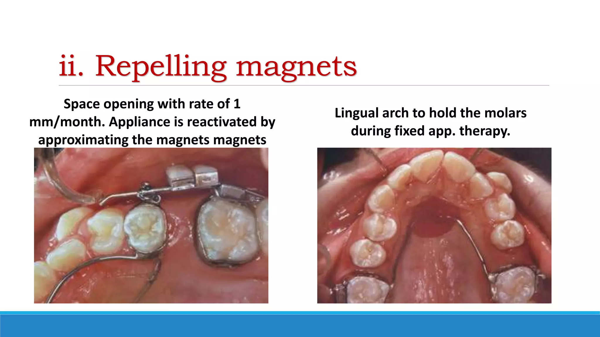 ii. Repelling magnets
Space opening with rate of 1
mm/month. Appliance is reactivated by
approximating the magnets magnets
Lingual arch to hold the molars
during fixed app. therapy.
 