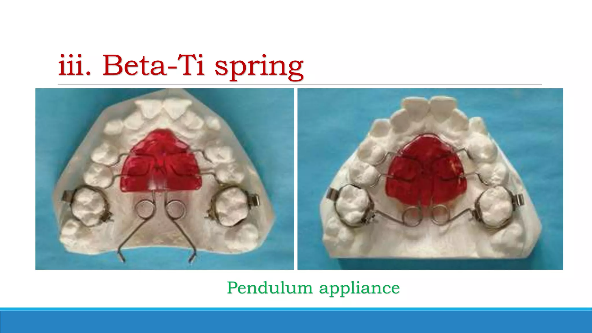 iii. Beta-Ti spring
Pendulum appliance
 