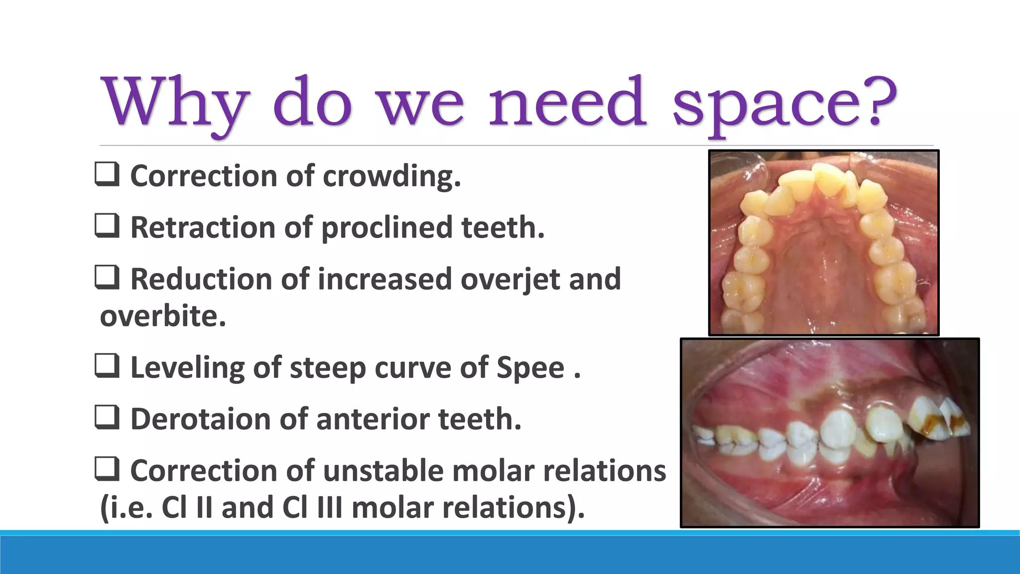 Why do we need space?
 Correction of crowding.
 Retraction of proclined teeth.
 Reduction of increased overjet and
overbite.
 Leveling of steep curve of Spee .
 Derotaion of anterior teeth.
 Correction of unstable molar relations
(i.e. Cl II and Cl III molar relations).
 