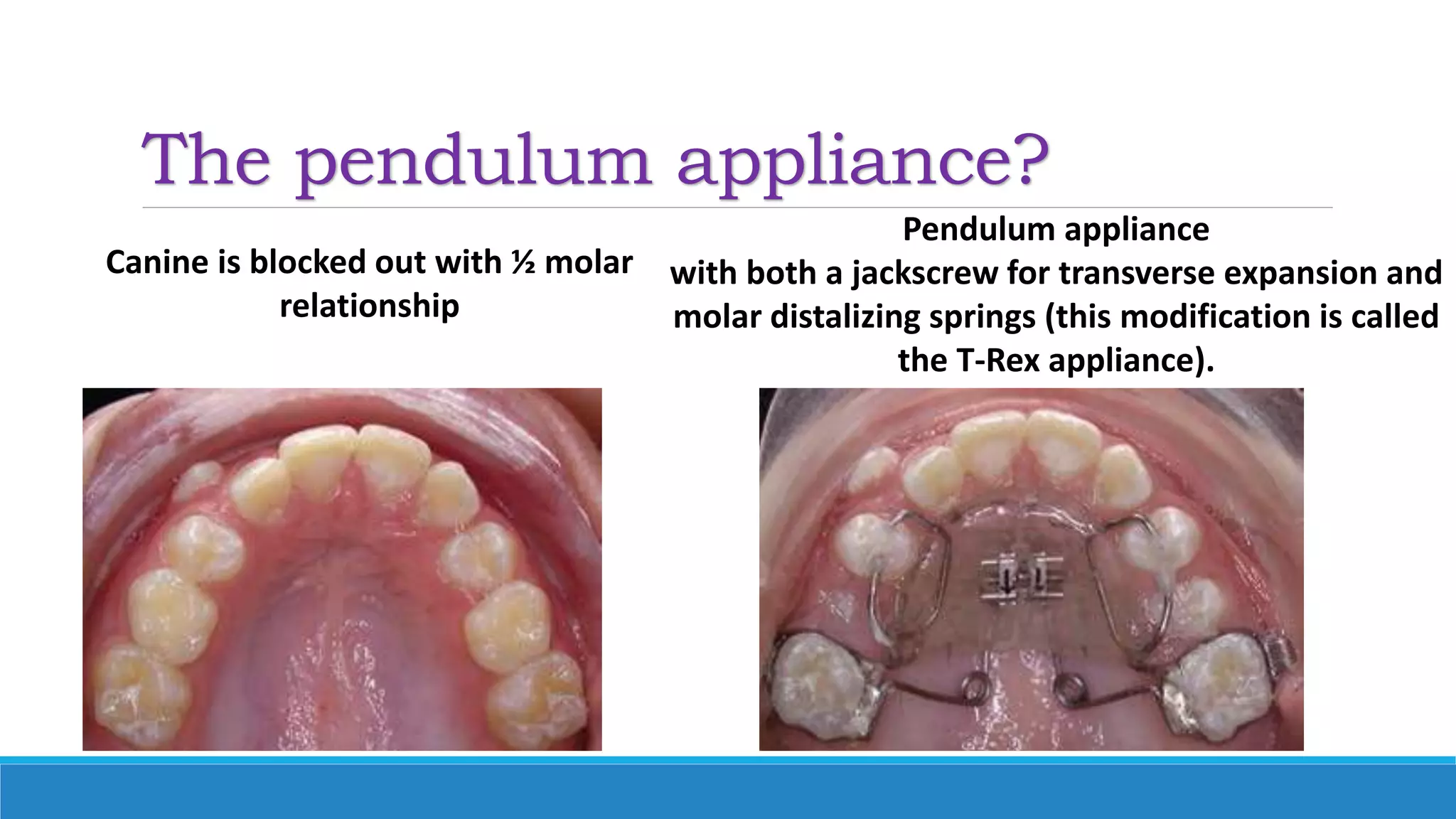 The pendulum appliance?
Canine is blocked out with ½ molar
relationship
Pendulum appliance
with both a jackscrew for transverse expansion and
molar distalizing springs (this modification is called
the T-Rex appliance).
 