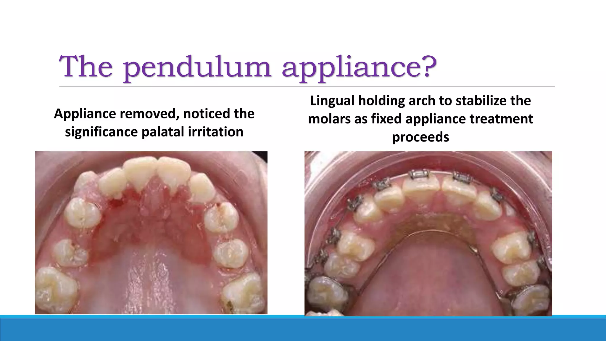 The pendulum appliance?
Appliance removed, noticed the
significance palatal irritation
Lingual holding arch to stabilize the
molars as fixed appliance treatment
proceeds
 