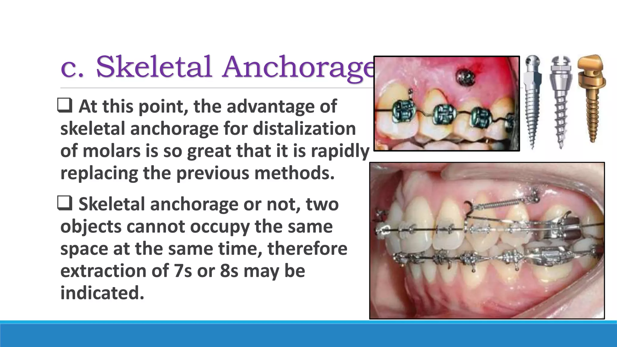 c. Skeletal Anchorage
 At this point, the advantage of
skeletal anchorage for distalization
of molars is so great that it is rapidly
replacing the previous methods.
 Skeletal anchorage or not, two
objects cannot occupy the same
space at the same time, therefore
extraction of 7s or 8s may be
indicated.
 