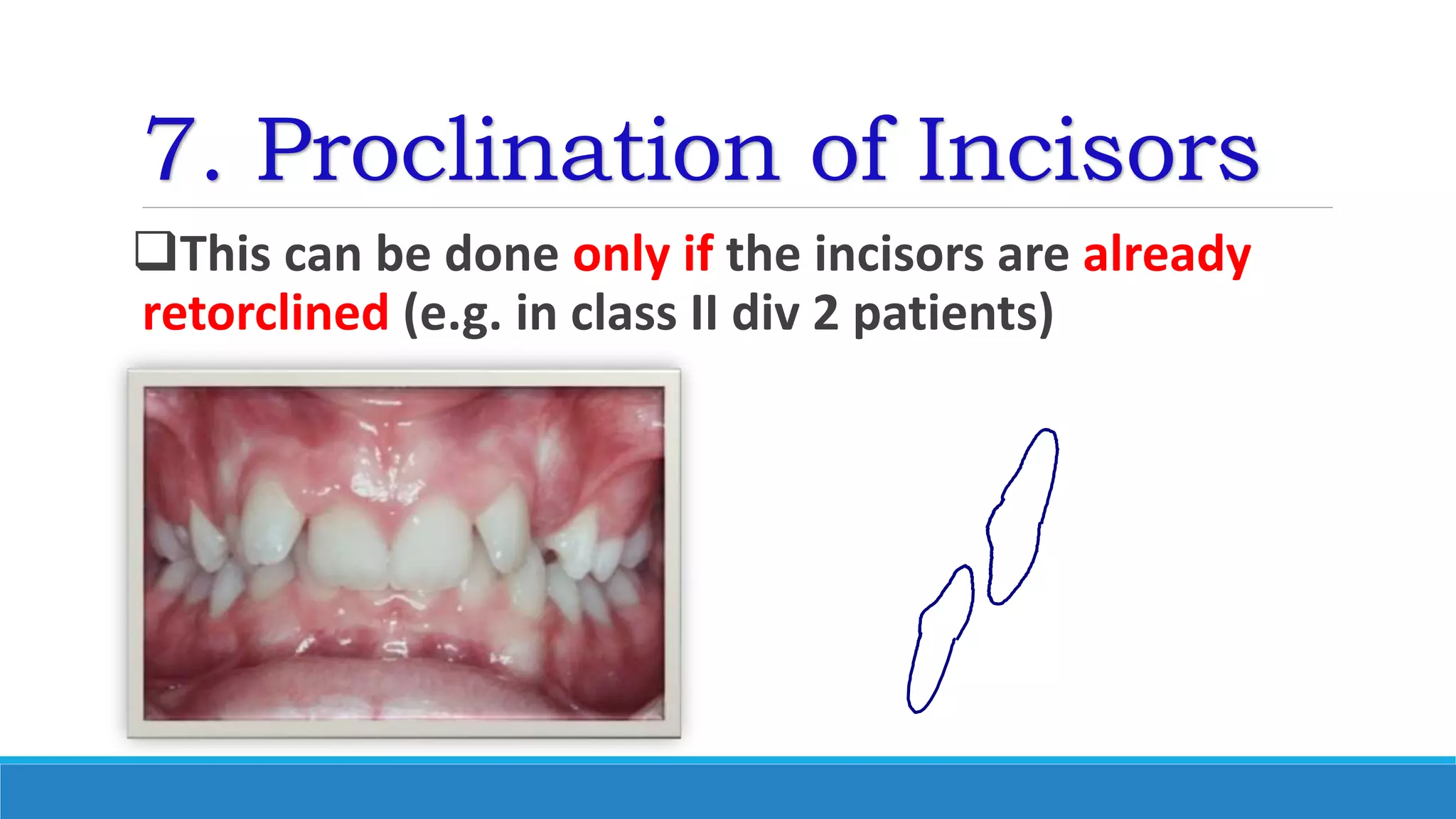 7. Proclination of Incisors
This can be done only if the incisors are already
retorclined (e.g. in class II div 2 patients)
 