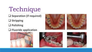 Technique
 Separation (if required)
 Stripping
 Polishing
 Fluoride application
 