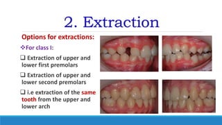 2. Extraction
Options for extractions:
For class I:
 Extraction of upper and
lower first premolars
 Extraction of upper and
lower second premolars
 i.e extraction of the same
tooth from the upper and
lower arch
 