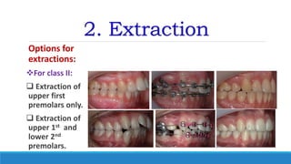 2. Extraction
Options for
extractions:
For class II:
 Extraction of
upper first
premolars only.
 Extraction of
upper 1st and
lower 2nd
premolars.
 