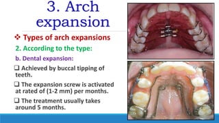 3. Arch
expansion
 Types of arch expansions
2. According to the type:
b. Dental expansion:
 Achieved by buccal tipping of
teeth.
 The expansion screw is activated
at rated of (1-2 mm) per months.
 The treatment usually takes
around 5 months.
 