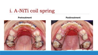 i. A-NiTi coil spring
Pretreatment Posttreatment
 