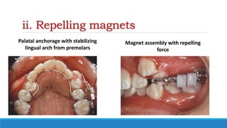 ii. Repelling magnets
Palatal anchorage with stabilizing
lingual arch from premolars
Magnet assembly with repelling
force
 