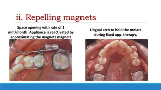ii. Repelling magnets
Space opening with rate of 1
mm/month. Appliance is reactivated by
approximating the magnets magnets
Lingual arch to hold the molars
during fixed app. therapy.
 