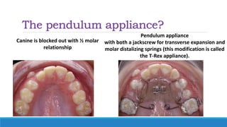 The pendulum appliance?
Canine is blocked out with ½ molar
relationship
Pendulum appliance
with both a jackscrew for transverse expansion and
molar distalizing springs (this modification is called
the T-Rex appliance).
 