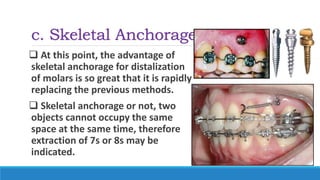 c. Skeletal Anchorage
 At this point, the advantage of
skeletal anchorage for distalization
of molars is so great that it is rapidly
replacing the previous methods.
 Skeletal anchorage or not, two
objects cannot occupy the same
space at the same time, therefore
extraction of 7s or 8s may be
indicated.
 