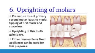 6. Uprighting of molars
 Premature loss of primary
second molar leads to mesial
tipping of first molar and
space loss.
 Uprighting of this tooth
gain space.
 Either removable or fixed
appliances can be used for
this purposes.
 