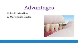 Advantages
 Avoid extraction.
 More stable results.
 