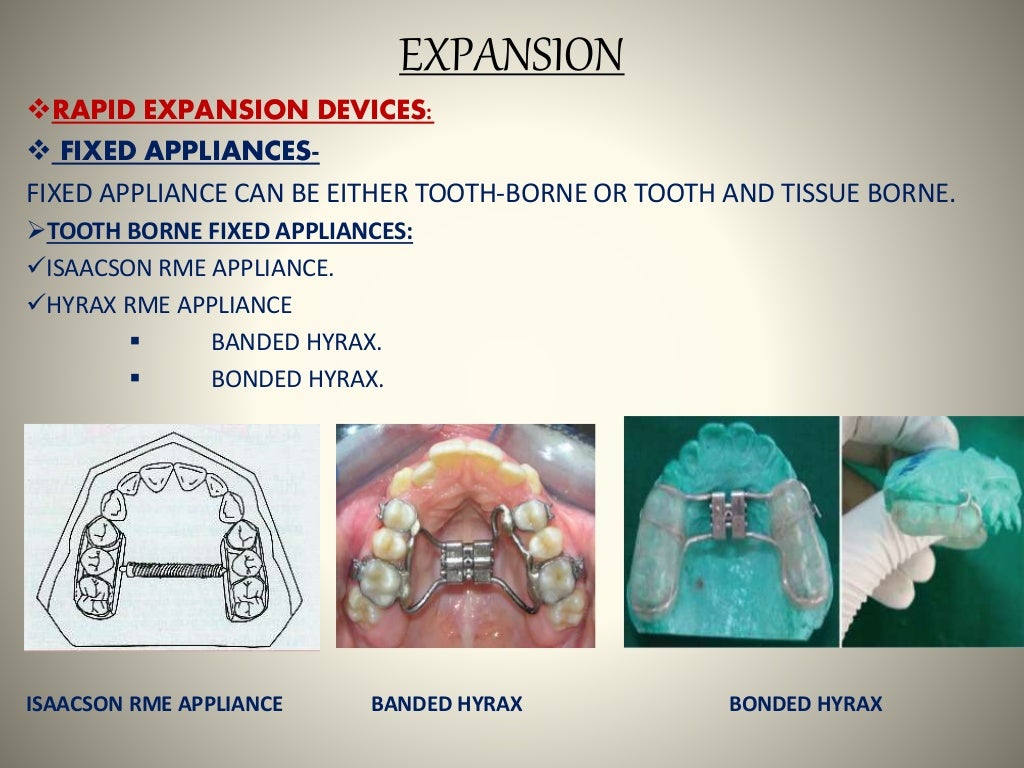 Space gaining methods ORTHODONTICS