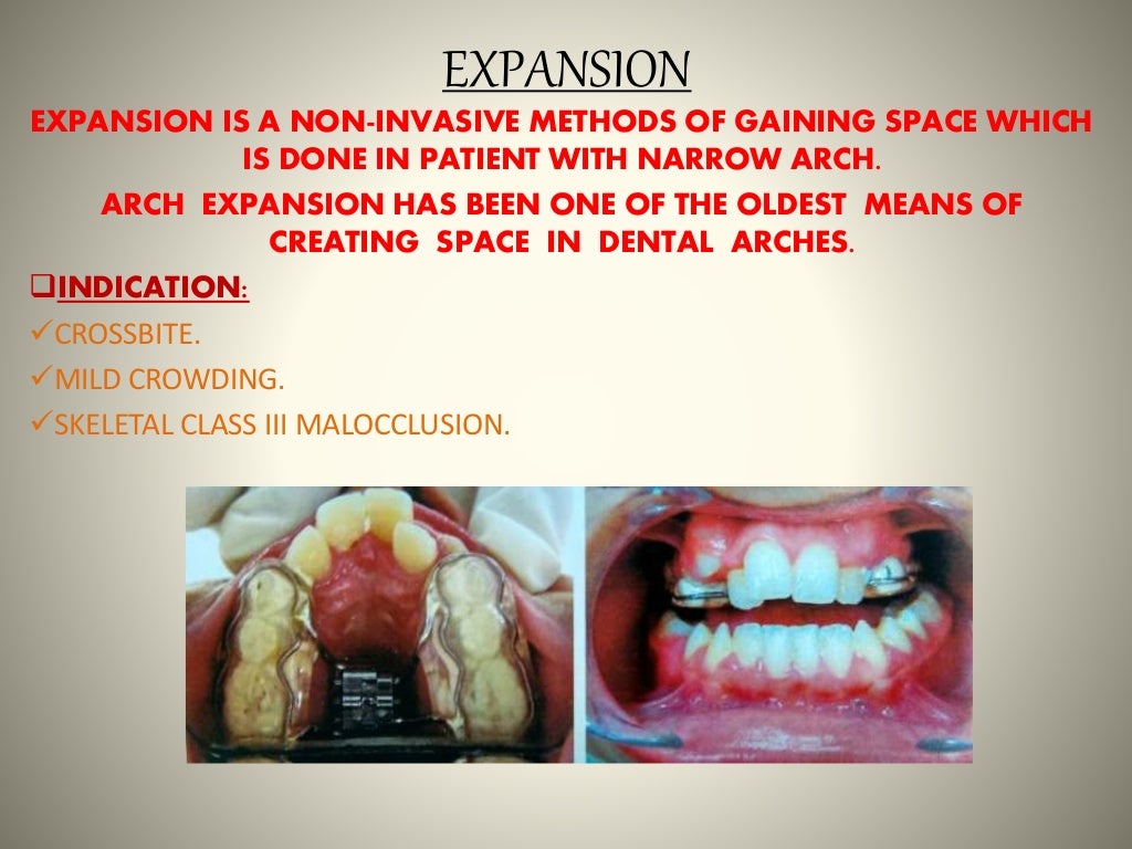 Space gaining methods ORTHODONTICS