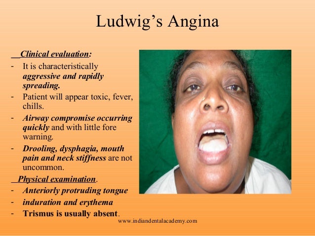ludwig s angina