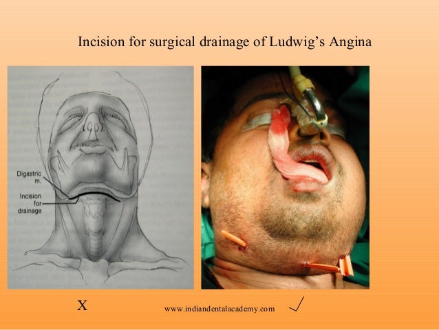 ludwig s angina
