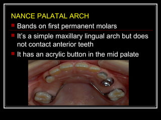 NANCE PALATAL ARCH
 Bands on first permanent molars
 It’s a simple maxillary lingual arch but does
  not contact anterior teeth
 It has an acrylic button in the mid palate
 
