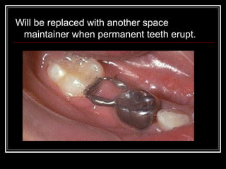Will be replaced with another space
 maintainer when permanent teeth erupt.
 