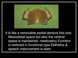It is like a removable partial denture Not only
   Mesiodistal space but also the vertical
   space is maintained. masticatory Function
   is restored in functional type Esthetics &
   speech improvement is seen
 