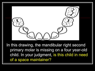 In this drawing, the mandibular right second
  primary molar is missing on a four year-old
  child. In your judgment, is this child in need
  of a space maintainer?
 