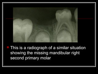    This is a radiograph of a similar situation
    showing the missing mandibular right
    second primary molar
 