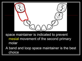 space maintainer is indicated to prevent
  mesial movement of the second primary
  molar
A band and loop space maintainer is the best
  choice
 