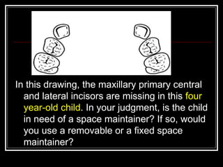 In this drawing, the maxillary primary central
  and lateral incisors are missing in this four
  year-old child. In your judgment, is the child
  in need of a space maintainer? If so, would
  you use a removable or a fixed space
  maintainer?
 