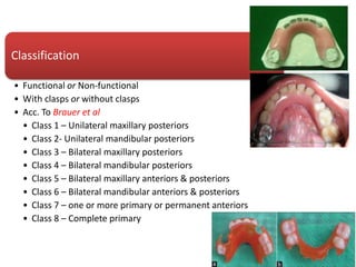 Classification
• Functional or Non-functional
• With clasps or without clasps
• Acc. To Brauer et al
• Class 1 – Unilateral maxillary posteriors
• Class 2- Unilateral mandibular posteriors
• Class 3 – Bilateral maxillary posteriors
• Class 4 – Bilateral mandibular posteriors
• Class 5 – Bilateral maxillary anteriors & posteriors
• Class 6 – Bilateral mandibular anteriors & posteriors
• Class 7 – one or more primary or permanent anteriors
• Class 8 – Complete primary
 