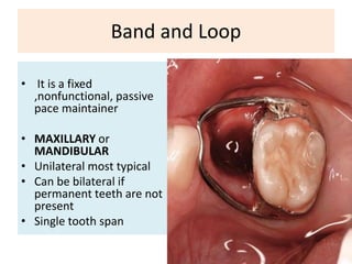 Band and Loop
• It is a fixed
,nonfunctional, passive
pace maintainer
• MAXILLARY or
MANDIBULAR
• Unilateral most typical
• Can be bilateral if
permanent teeth are not
present
• Single tooth span
 
