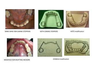 SAME WIRE FOR CANINE STOPPERS WITH CANINE STOPPERS
MODIFIED FOR ERUPTING INCISORS CHAWLA modification
HOTZ modification
 