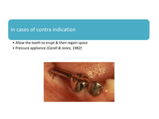 In cases of contra indication
• Allow the tooth to erupt & then regain space
• Pressure appliance (Caroll & Jones, 1982)
 