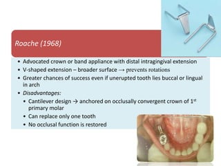 Roache (1968)
• Advocated crown or band appliance with distal intragingival extension
• V-shaped extension – broader surface → prevents rotations
• Greater chances of success even if unerupted tooth lies buccal or lingual
in arch
• Disadvantages:
• Cantilever design → anchored on occlusally convergent crown of 1st
primary molar
• Can replace only one tooth
• No occlusal function is restored
 